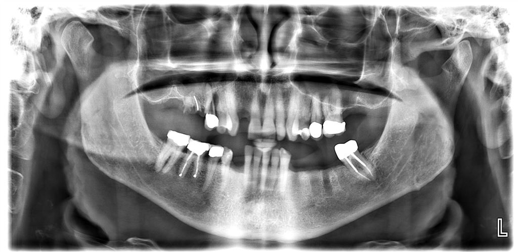 implantes dentales ultimos avances